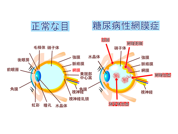 糖尿病網膜症の 4 段階
