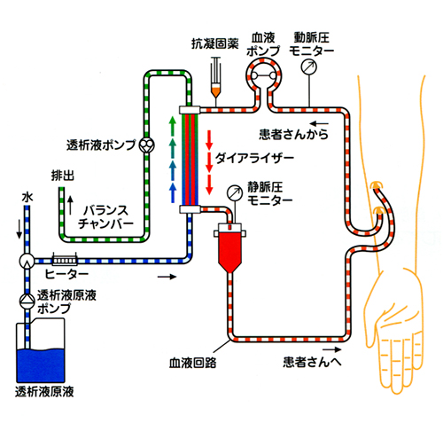 人工透析