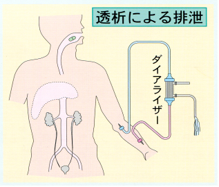 人工透析